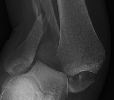 Ankle Fracture Clear Syndesmotic Injury
